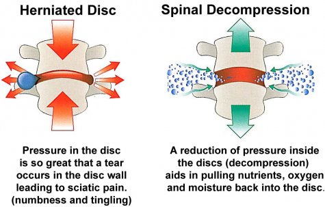 Spinal Decompression